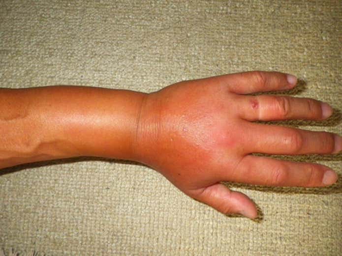 アシナガバチに刺された様子