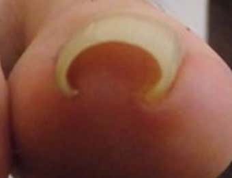 中度の巻き爪