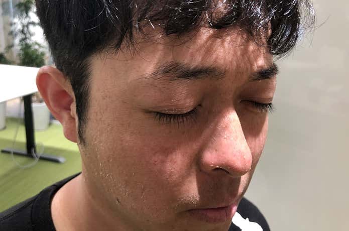 日焼け事例①