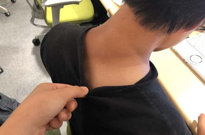 日焼け事例③