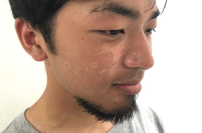 日焼け事例④