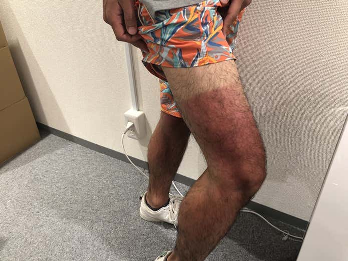 足の日焼け