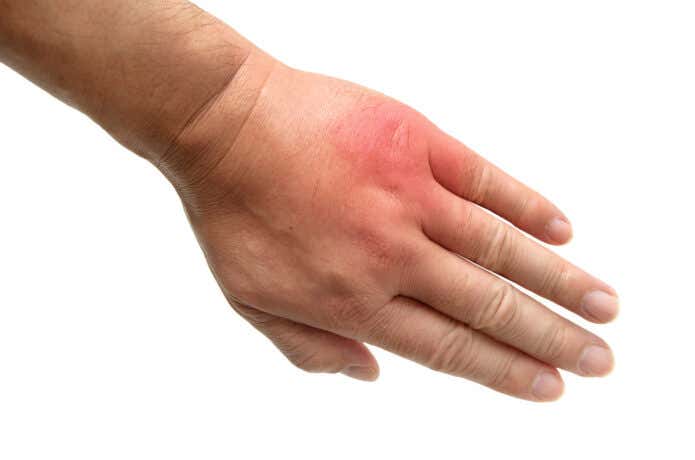 刺されたイメージ