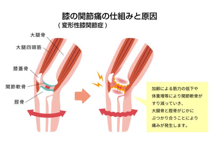 変形性膝関節症の仕組みと原因