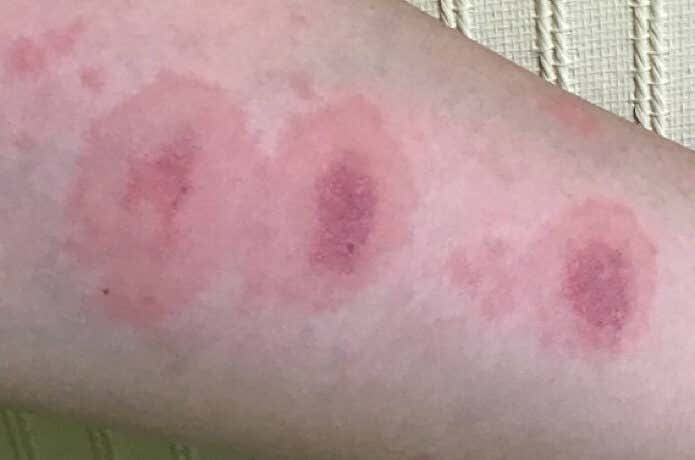 ウルシにかぶれた腕