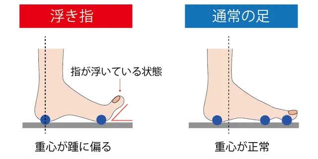 浮足とは
