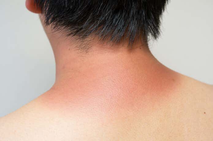 首の後ろが日焼けしすぎて赤くなっている男性